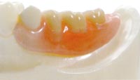 水野歯科クリニック　入れ歯　ノンクラスプ01